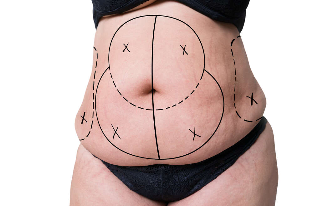 Enlever la graisse du ventre : que faire pour y arriver ?