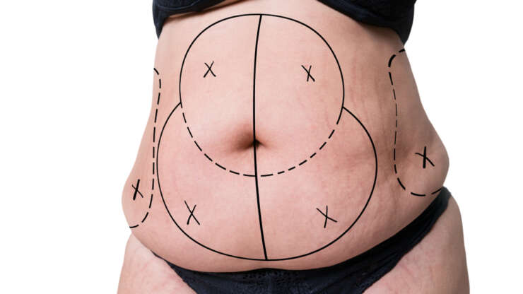Enlever la graisse du ventre : que faire pour y arriver ?